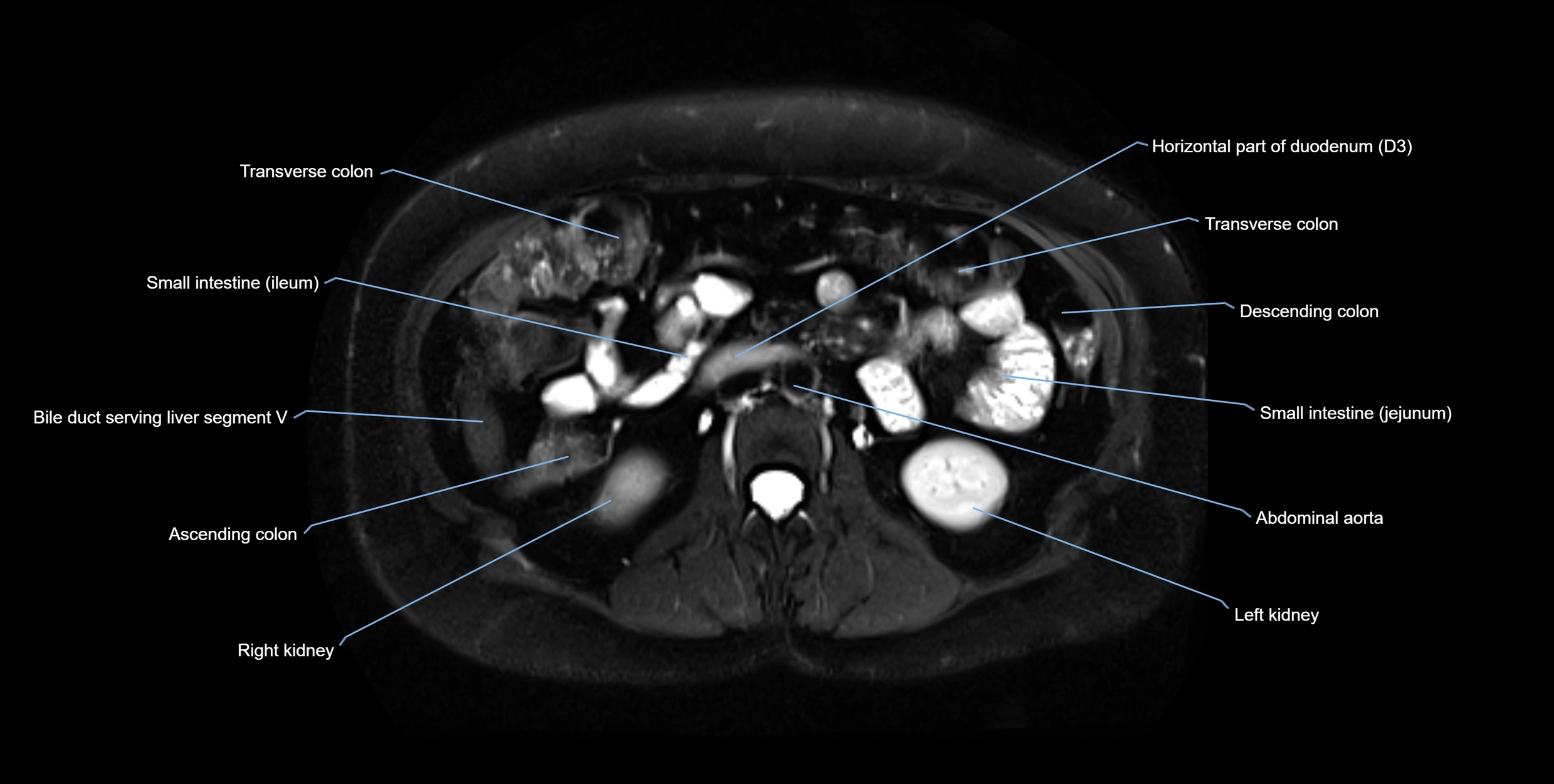 MRI MRCP axial cross sectional anatomy 3T radiology  image-img-10001-00033.webp